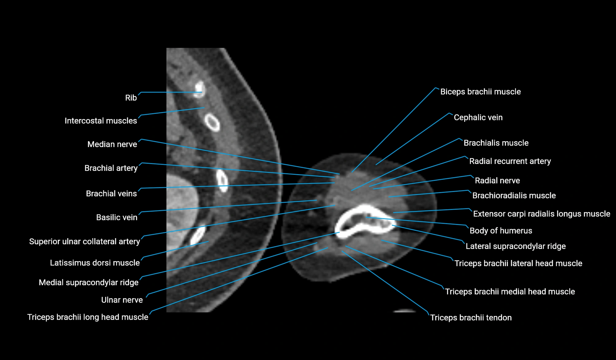 CT upper arm axial  cross sectional anatomy labelled radiology image -00360.webp
